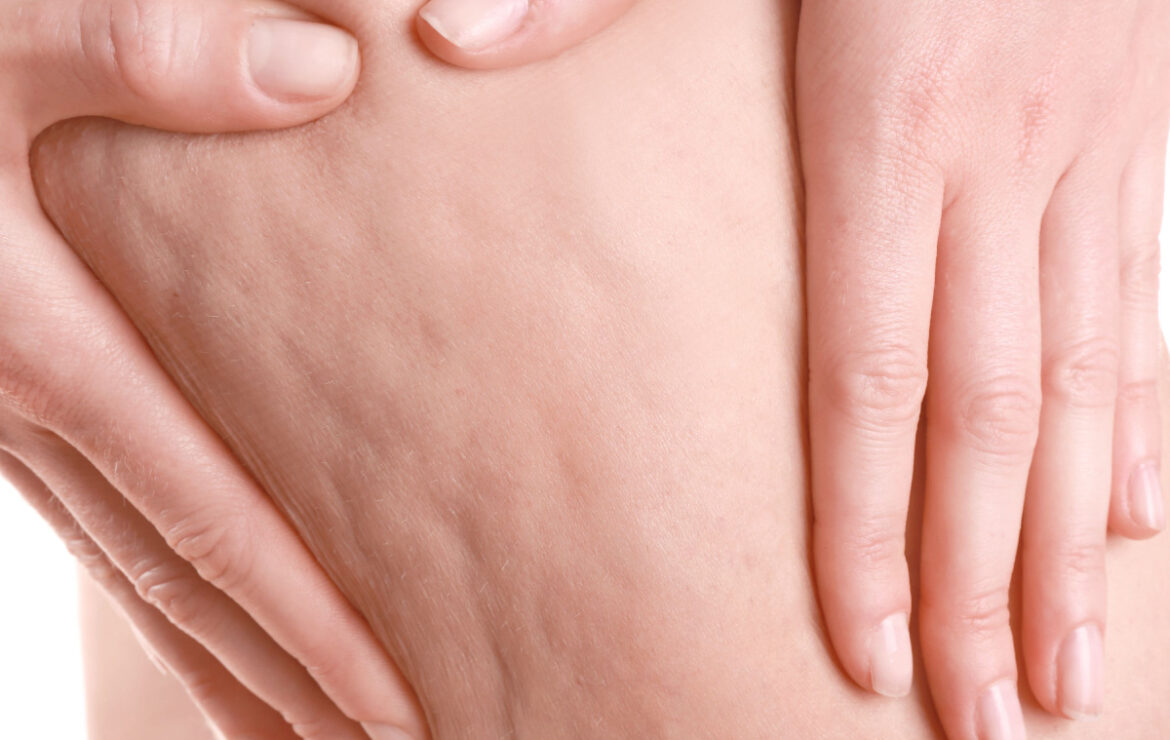 Cellulite ed Onde d’Urto