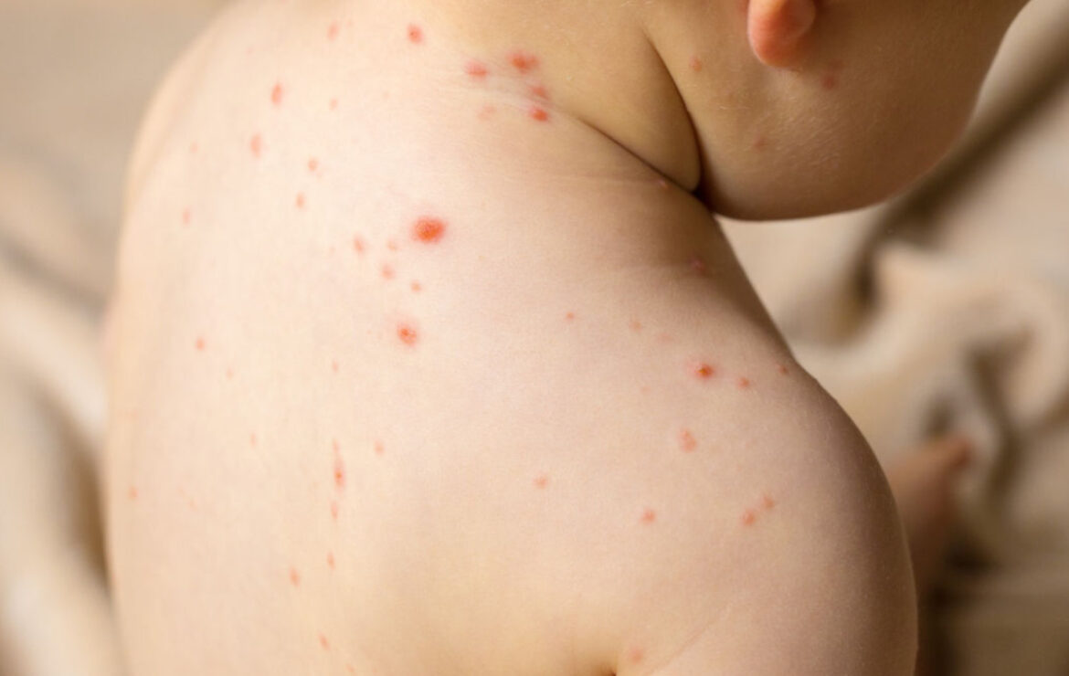 Morbillo: sintomi e vaccino