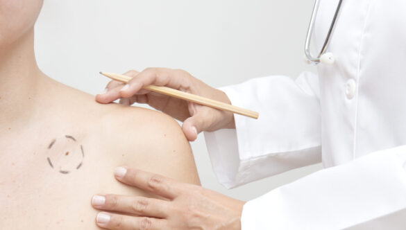Melanoma e Prevenzione