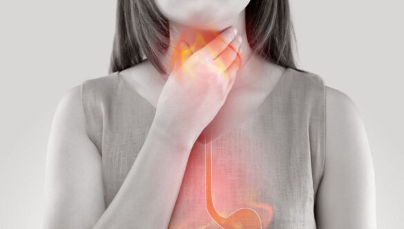 Che cos’è il reflusso gastroesofageo
