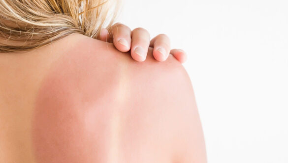 Eritema Solare: come prevenirlo e curarlo
