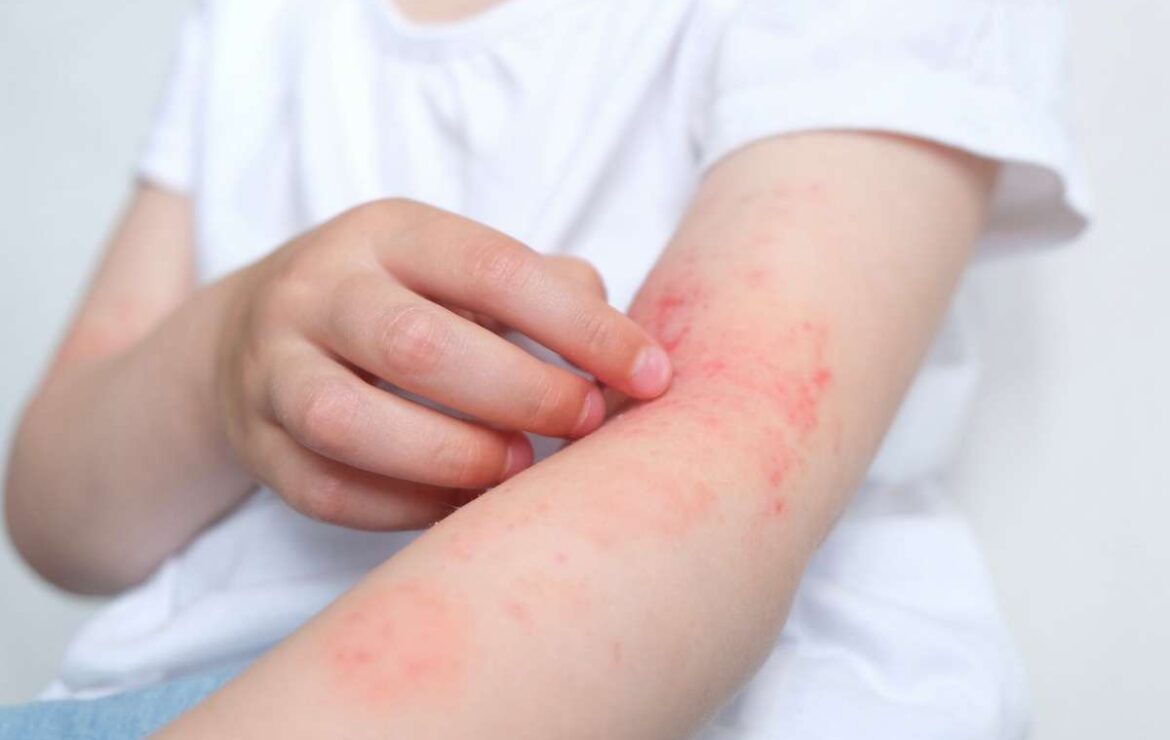 Dermatite Atopica