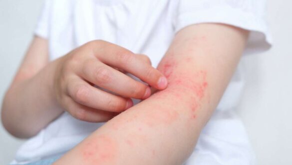 Dermatite Atopica